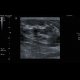 Calcifications in breast: US - Ultrasound